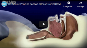 Principe daction orthese Narval ORM